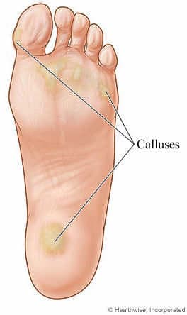 caluses